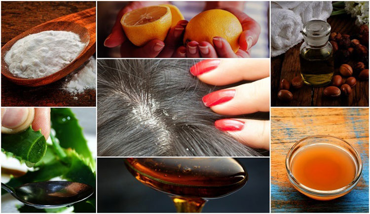 10 Effective Home Remedies For Dandruff | Best Herbal Health