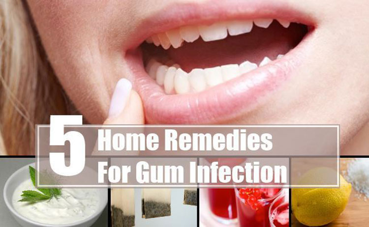 5 Home Remedies To Help You Treat Gum Infections | Best Herbal Health