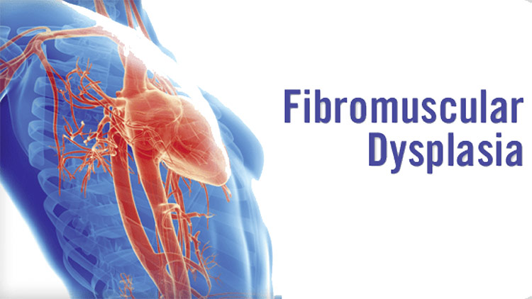 Fibromuscular Dysplasia: Causes, Symptoms, Diagnosis and Treatment