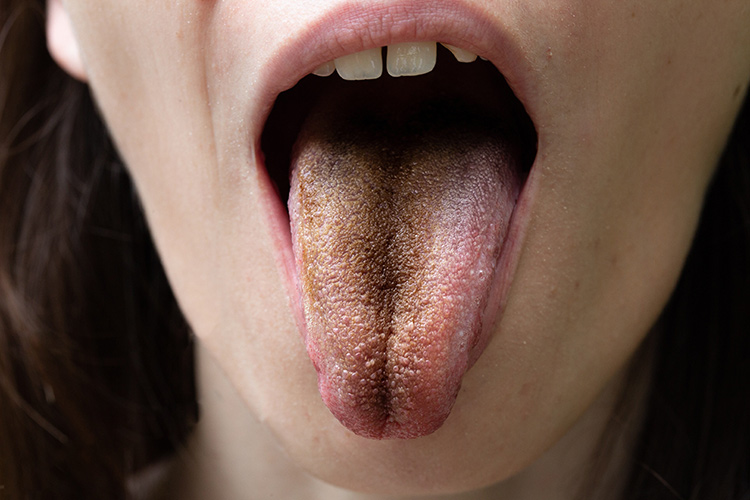 Black Hairy Tongue: Symptoms, Causes and Treatment