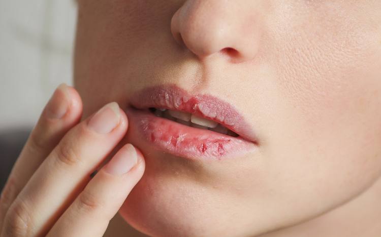 Causes Of Dry Lips 